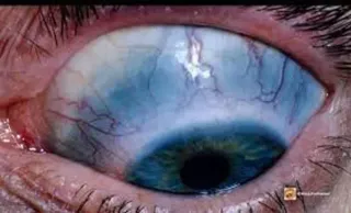 Close-up of an eye showing a blue-grey tint in the white of the eye