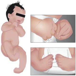 Newborn hands and feet held in fixed, bent positions