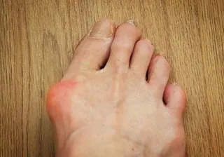 A foot with the big toe angled inward and a bump at its base