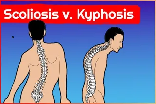 Curved spine seen from the back and side