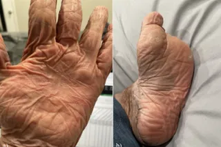 Palm of a hand with deep extra creases and wrinkling