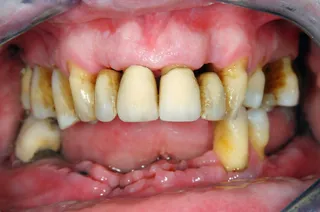 Inflamed, receding gums with exposed tooth roots