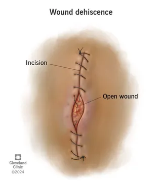 A healing wound that has reopened along its edges